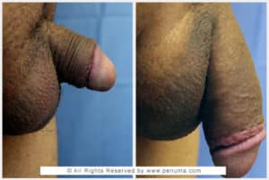 penuma penis implant before and after with Dr. Kambiz Tajkarimi