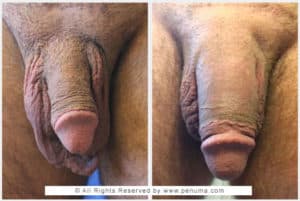 penuma penis implant before and after in northern Virginia