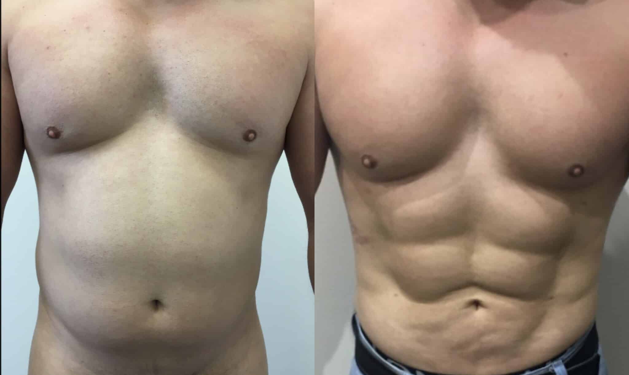 liposuction for men