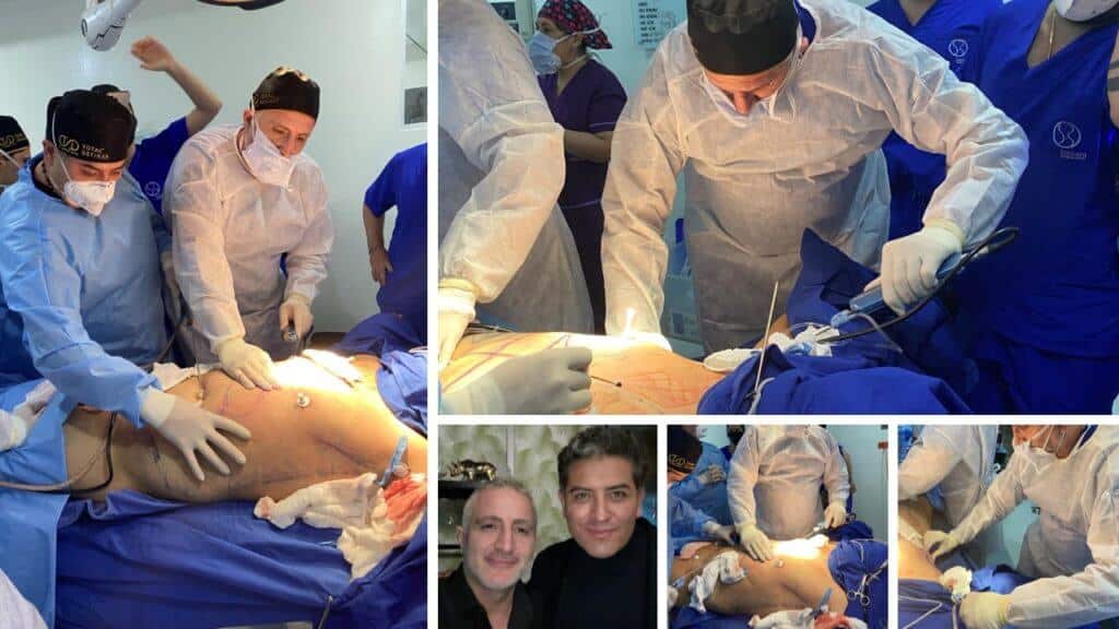 High Definition LIPOSUCTION | Better Body Contouring