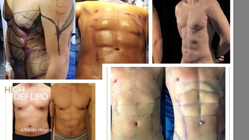LIPOSUCTION Better Body MD