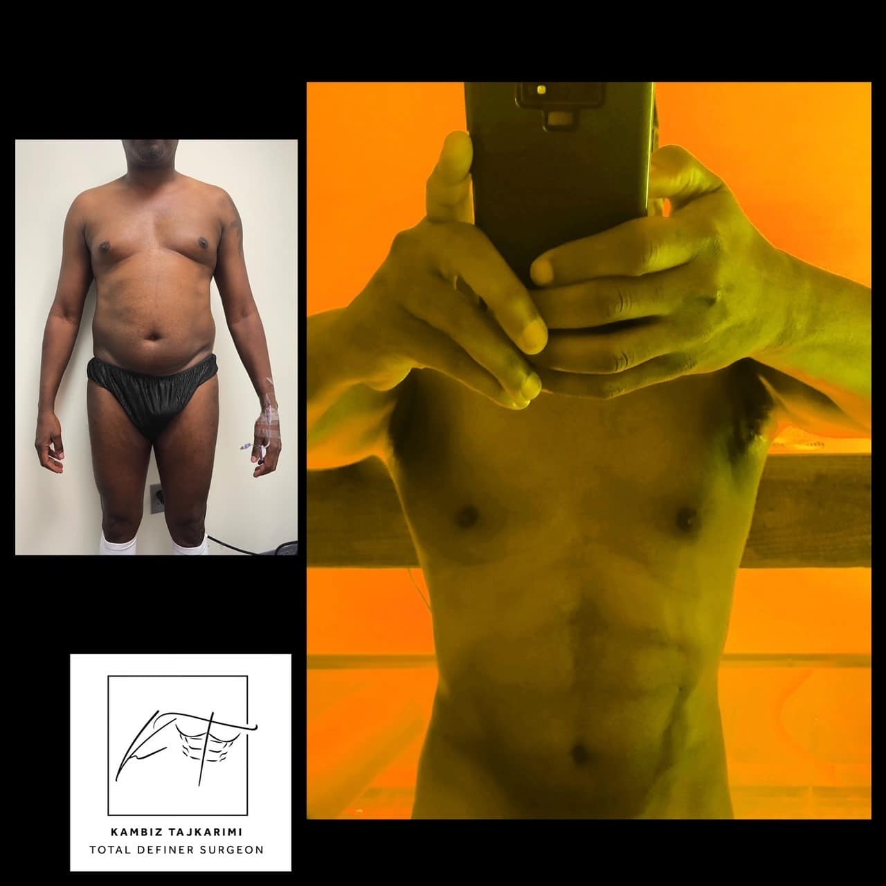 HD lipo Tajkarimi 1