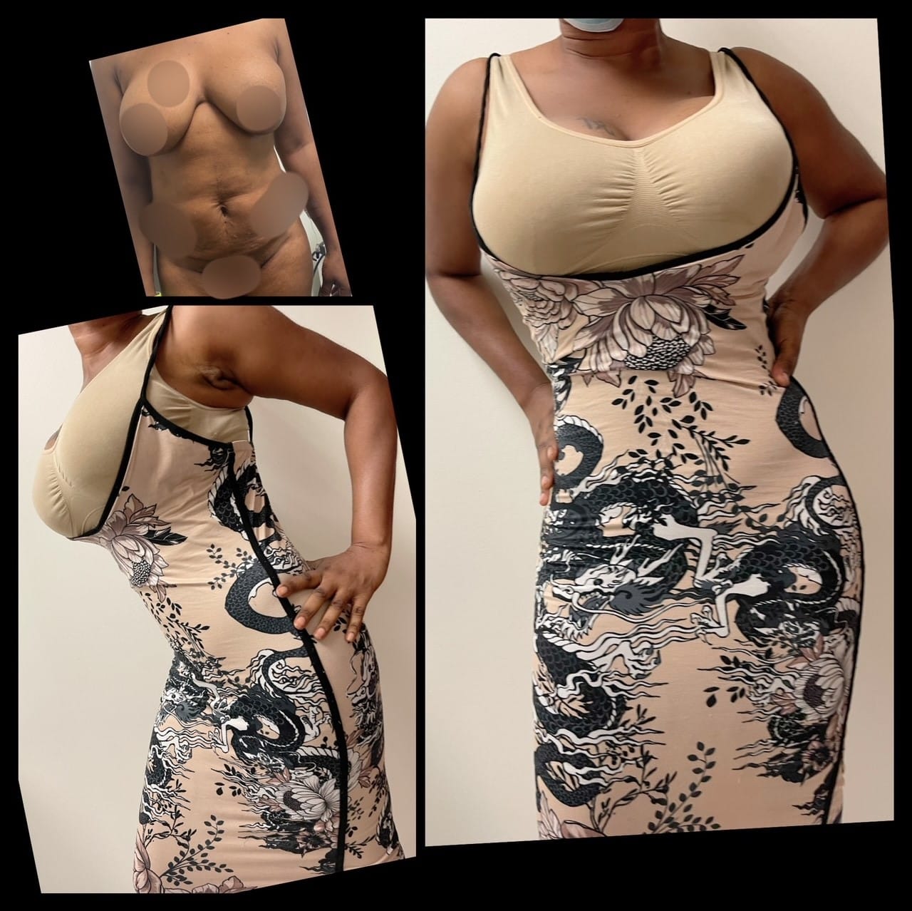 HD lipo tummy tuck