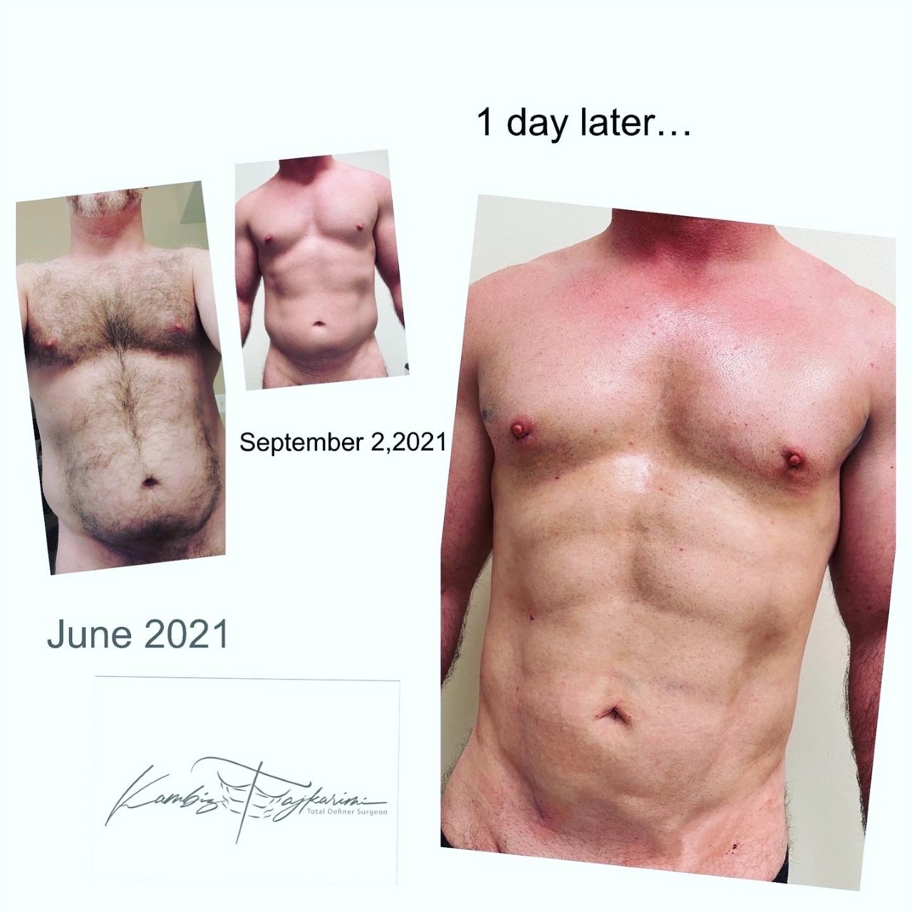 tajkarimi male lipo