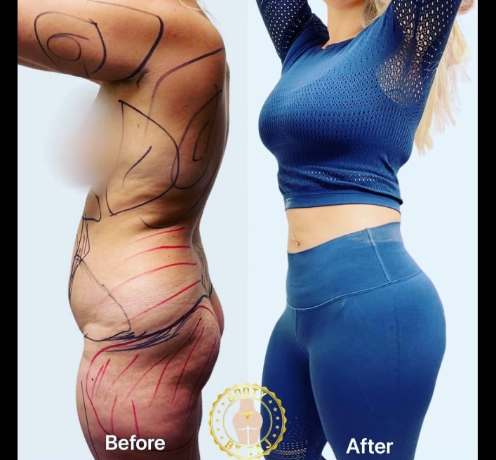 TummyTuck-Results-010