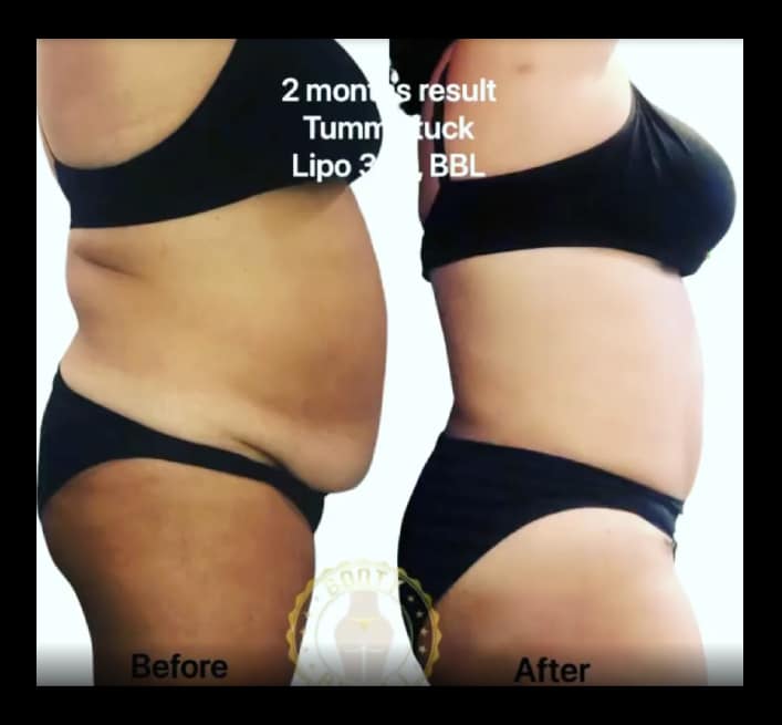 TummyTuck-Results-11