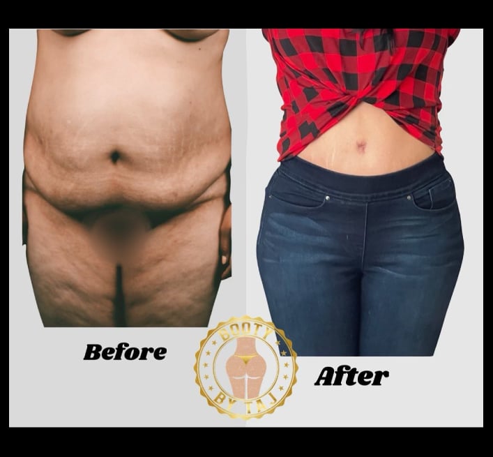 TummyTuck-Results-13