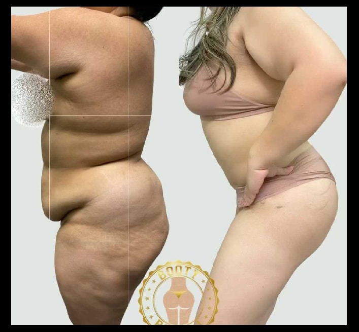 TummyTuck-Results-15