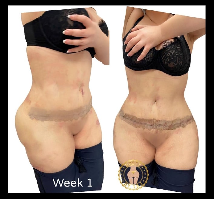 TummyTuck-Results-16