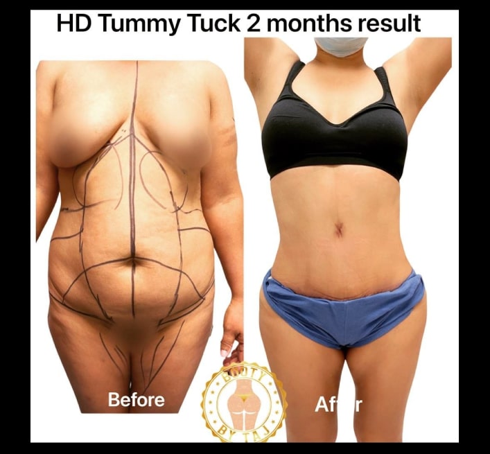 HD tummy tuck results2 months post-op