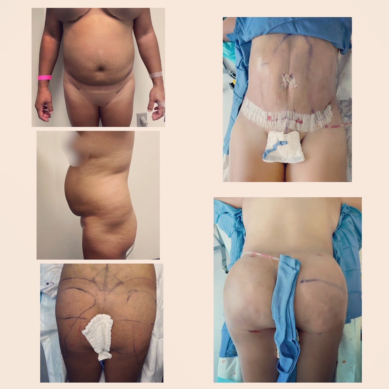 tajkarimi HD lipo 1